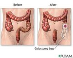 colostomy-bag.jpg
