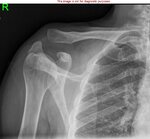 dislocated_collar_bone.jpg